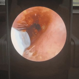 VisionEar™-Nettoyeur d’Oreilles Intelligent HD